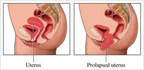 Cystocele - Hình ảnh minh họa